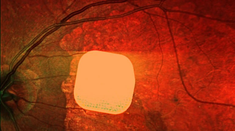 Технології - Британські лікарі частково повернули зір пацієнтам за допомогою мікрочипа